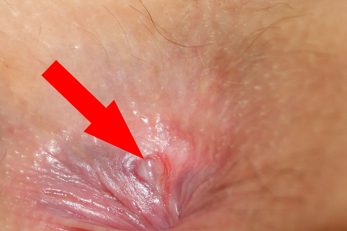 An anal fissure: a small tear in the skin at the edge of the back passage, marked with a red arrow