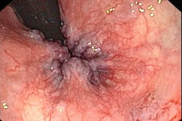 Internal piles seen through a scope turned back at the exit of the bowel: swollen, bluish cushions around the dark tube of the scope